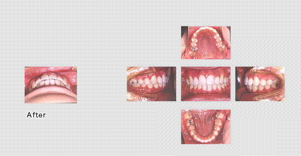 歯並びの状態