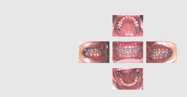 手術を受ける前の歯並び