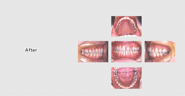 顎関節症の再発もなく歯並びも安定