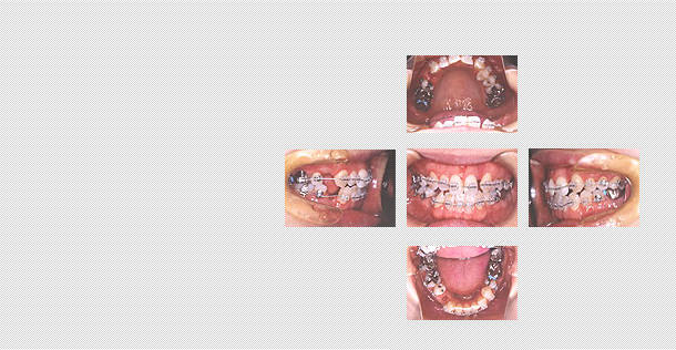歯の奇形で小さいく形が悪い歯を抜歯
