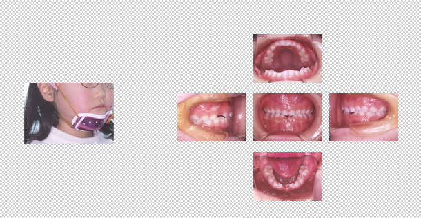 乳歯から永久歯への生え変わり