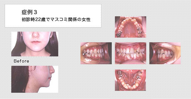 顔面非対称の矯正治療 症例 左右のズレ 恵佑会矯正歯科クリニック