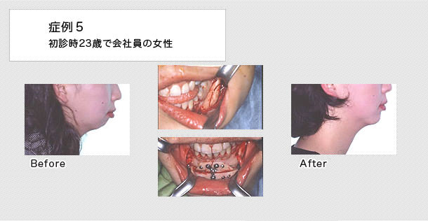 外科的矯正治療の症例 前歯 出っ歯 恵佑会矯正歯科クリニック