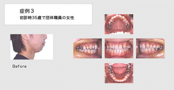 先天性欠如歯治療の症例 側切歯 恵佑会矯正歯科クリニック