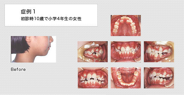 叢生 でこぼこ歯並び 治療の症例 八重歯 乱杭歯 恵佑会矯正歯科クリニック