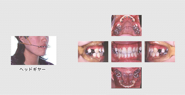舌側矯正治療の症例｜上下の歯｜恵佑会矯正歯科クリニック