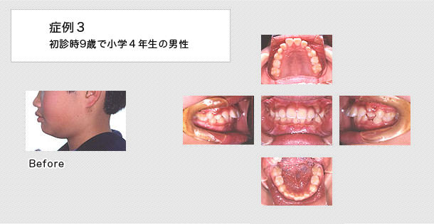 出っ歯　ケース３