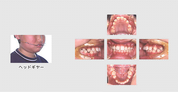 出っ歯　ケース３